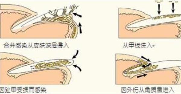 醋泡大蒜治疗灰指甲的方法