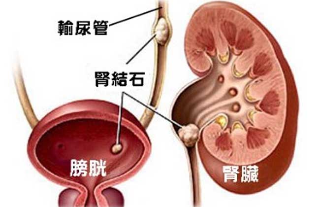 肾结石是怎么形成的