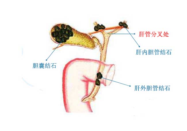 肝内胆管结石位置图图片