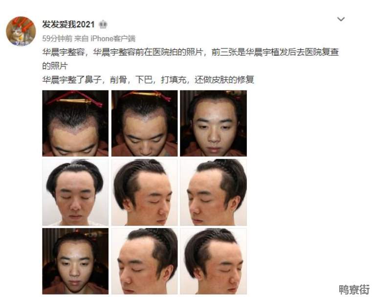 花花整容到什么程度了 花花整容前后对比